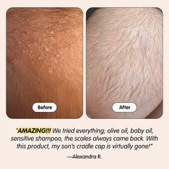Bye-Bye Cradle Cap Bundle